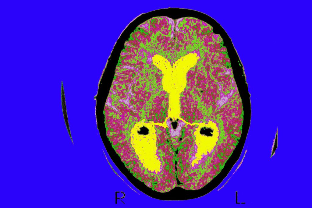 Alzheimer’s Drug Donanemab Helps Most When Taken Early in Disease